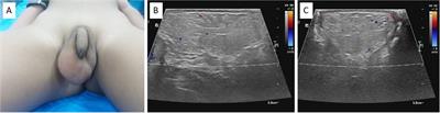 Primary scrotal lipoma in a child: a rare case report and review of literature